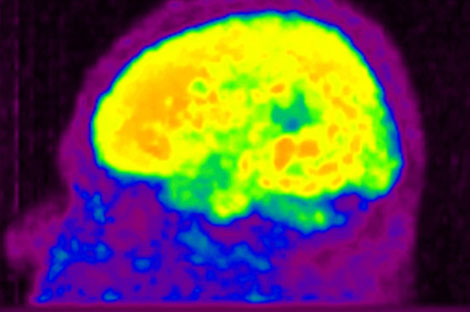 Alzheimer
