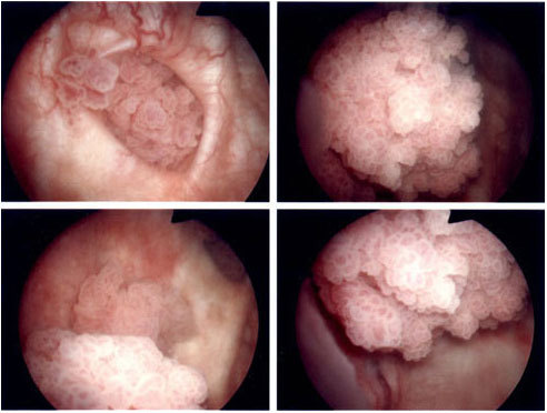 Bladder Cancer