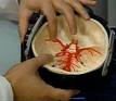 Within 4.5 Hrs After Stroke, Blood Clot Dissolving Drug Can Save Patients