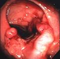 A Gene Related To Hormone Adiponectin Can Decrease Colon Cancer Risk 