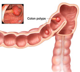 Colorectal Cancer Screening