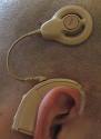 Deafness May Be Cured With The Innovative Gene Therapy  