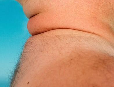''Fat neck'' may signal heart risk