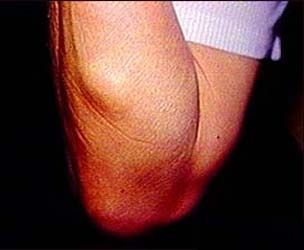 Fatty deposits impair heart function