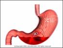 GI Bleeding After Stroke Raises Death Risk 