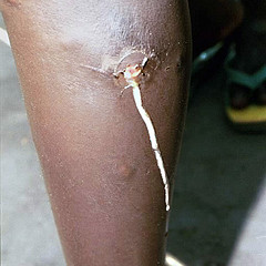 Guinea worm disease near eradication