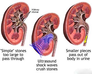 Kidney stones can indicate the onset of gout