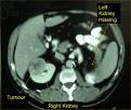 Kidney Cancer Treatment Needs Individualized Treatment Approach