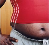 Dutch obesity clinic offers unique long-term treatment