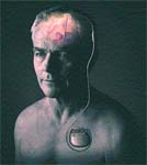Parkinson's Disease