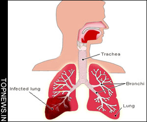 Older men more likely to die after pneumonia than women