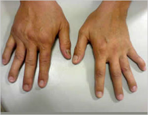 Identify polyarthritis quickly for best treatment