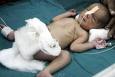 7-Month-Old Becomes Youngest Indian To Undergo Liver Transplant