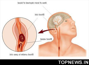 New treatment may restore speech to stroke, brain injury sufferers