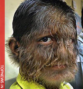 ‘Cure’ for Indian ‘werewolf boy’ found