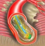 Angioplasty