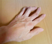 Arthritis Hand