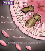 Cancer Growth