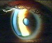 Eye Development