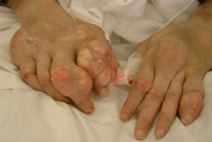 Vitamin C may help prevent gout in men