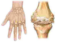 Inflammatory Disease