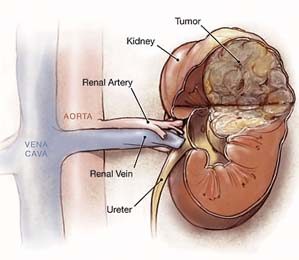 Kidney Cancer