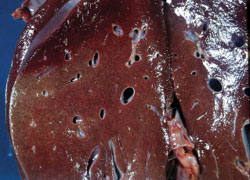 Fatty Liver