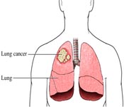Lung Cancer