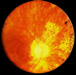 Macular Degeneration