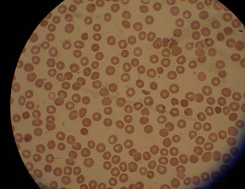 malaria 