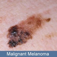Genetic mutation ‘triggers most melanoma''
