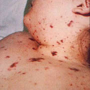 Bacterial Meningitis Skin Rash