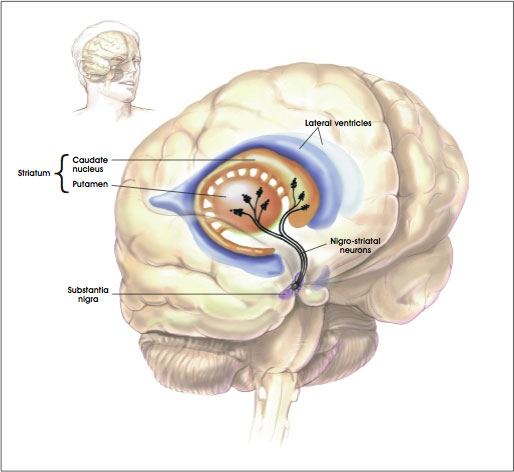 parkinsons