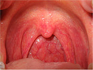 Ranbaxy Clarithromycin FDA Pharyngitis