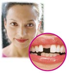 Tooth Loss