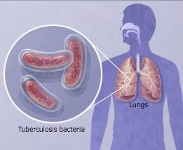 Drug-Resistant Tuberculosis